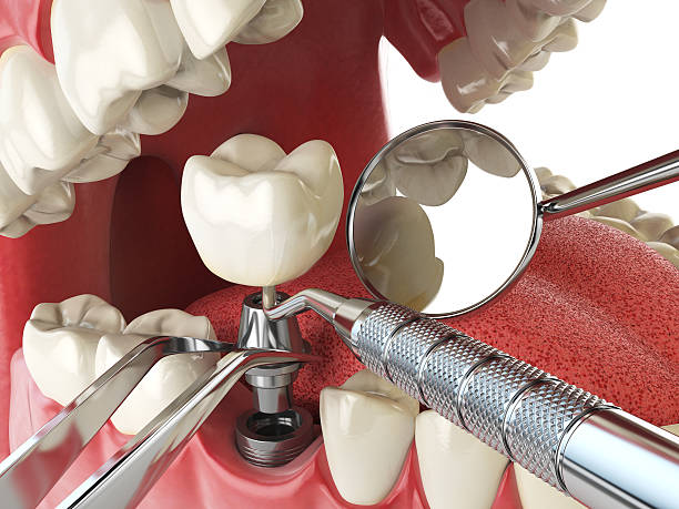 Best Emergency Treatment for Dental Infections or Abscesses in Roseland, NJ
